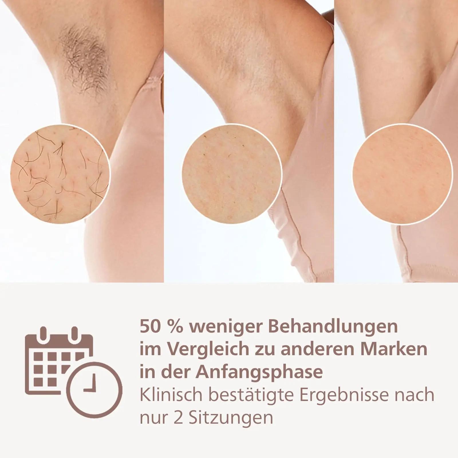 Philips Lumea IPL 8000 – mugav karvade eemaldus kodus – kasutusnäide