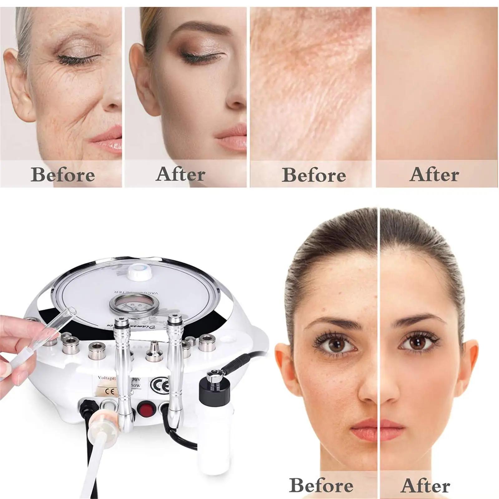 TwoWin professionaalne mikrodermabrasioon – pilt 6